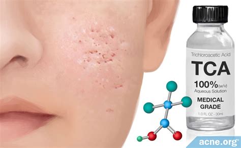 How Trichloroacetic Acid TCA Reduces Acne Scars Acne Org