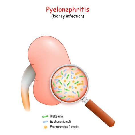 Pielonefritis Akut Foto Stok Potret And Gambar Bebas Royalti Istock