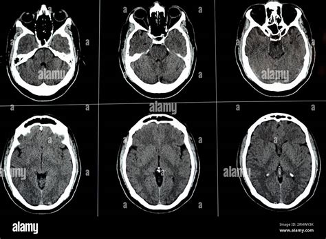 Brain Ct Scan Showing Brainstem Cavernoma Right Centrum Semiovale