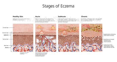 Stages of Eczema - Labelled – Medical Stock Images Company