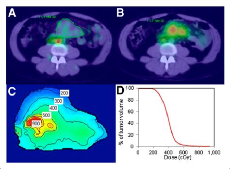 Imaging And Dosimetry Day 0 Posttracer A And Day 2 Posttherapy B