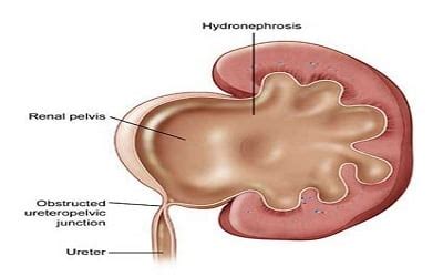 Ureteropelvic Junction Obstruction - Urocare Bangalore