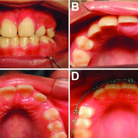 (PDF) Peripheral Calcifying Odontogenic Cyst: A rare case report