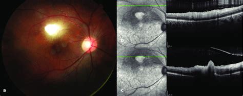 Fundus Photo Of A Patient With Toxoplasmic Retinochoroiditis Igm With