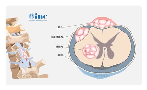 长了脊髓肿瘤是怎么样一种体验？脊髓髓内肿瘤神经系统肿瘤手术 健康界