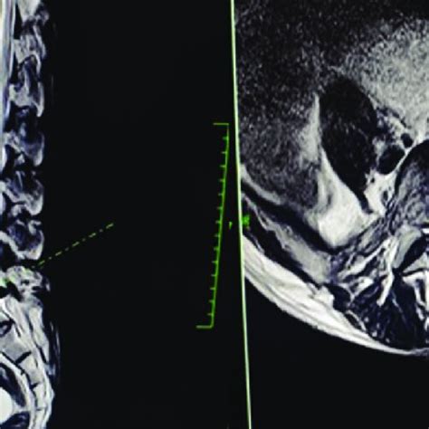 Preoperative Magnetic Resonance Imaging Mri Case Pre Operative Mri Download Scientific Diagram