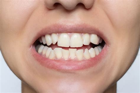 Treatments To Fix Crooked Teeth Long Island Ny