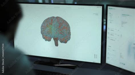 Ultrasound Patients Brain Scan In Analysis For Tumor Illness ...