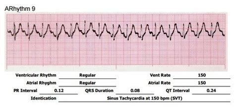 Supraventricular Dysrhythmias Flashcards Quizlet