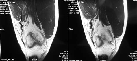 An Injury From Doing Squats In The Gym Vastus Lateralis Tendon