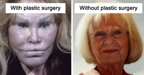 Celebrity Plastic Surgery Gone Wrong Before And After