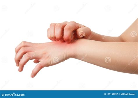 Woman Has Skin Rash Itch On Arm Stock Image Image Of Itch Dermatitis