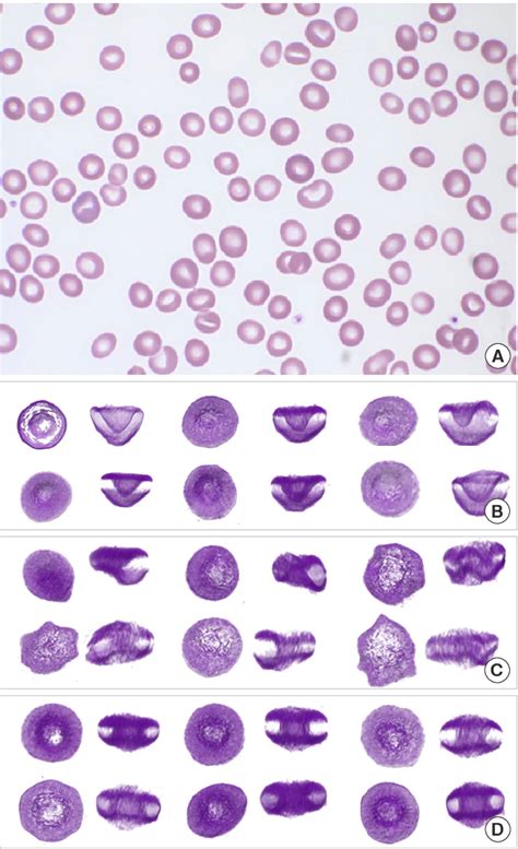 Red Blood Cell Morphology Grading