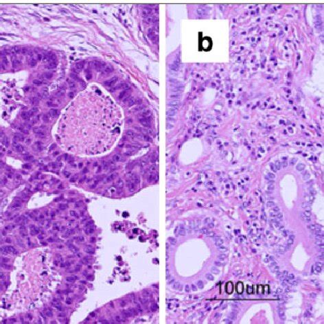 The histological findings. (a) The histological findings of the sigmoid ...