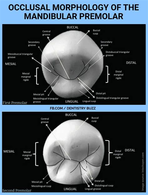 Permanent Maxillary First Molar Distal Aspect Tooth Morphology Hot Sex Picture