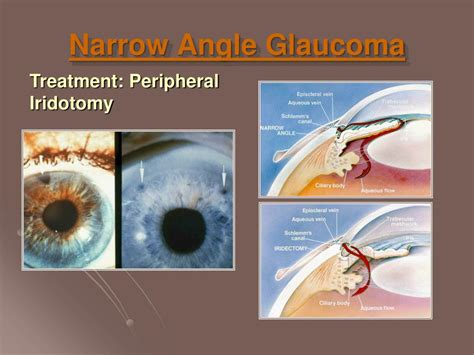 Ppt Glaucoma Powerpoint Presentation Free Download Id 177697