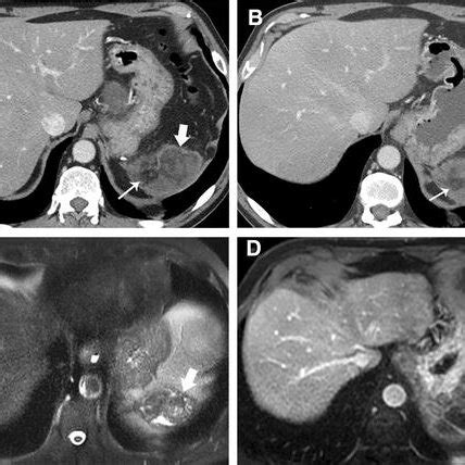 An 82-year-old man post modified Appleby procedure 1 month ago for... | Download Scientific Diagram