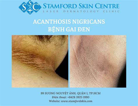 ACANTHOSIS NIGRICANS -" Dark neck"