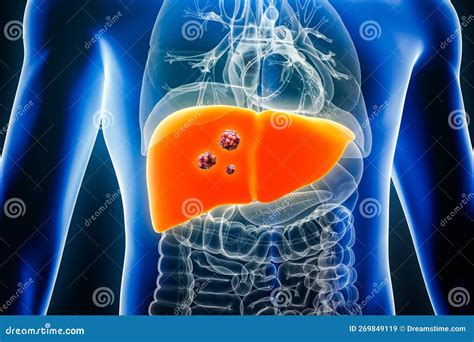 Liver Cancer With Organs And Tumors Or Cancerous Cells 3d Rendering Illustration Anatomy