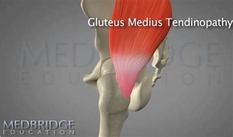 Treatment for Gluteus Medius Tendinopathy - Request Physical Therapy