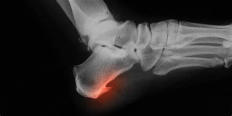 Bone Spurs Symptoms Treatment And More The Orthopedic Clinic