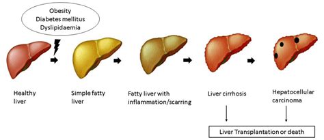 Fatty liver disease: a condition caused by modern day lifestyle – Atlas ...