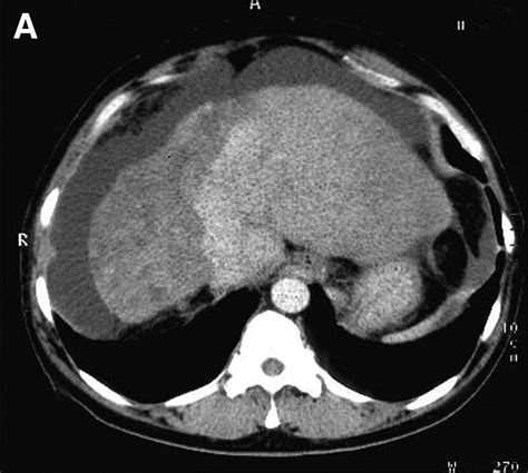 Hepatic Epithelioid Hemangioendothelioma Clinical Gastroenterology