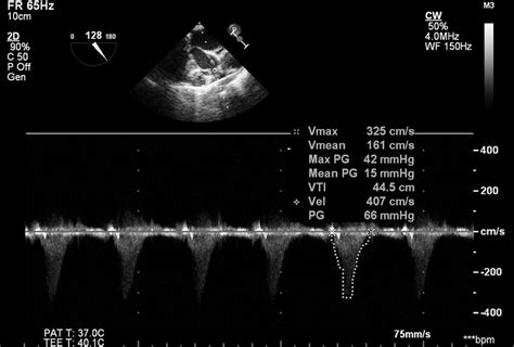 Transesophageal Echocardiography Transgastric Long Axis View