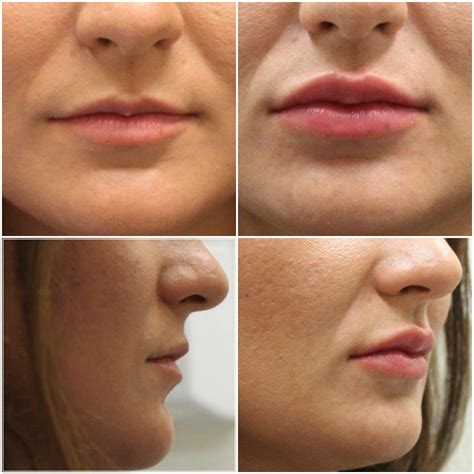 Makeup Wrinkles Cover Wrinkles Dermal Fillers Lip Fillers Facial