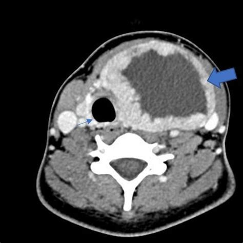 Cect Shows A Huge Left Thyroid Nodule With Deviation Of The Trachea To