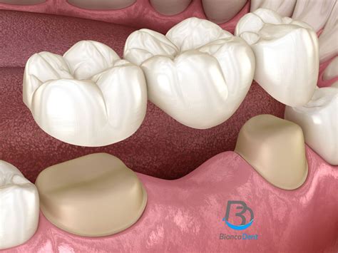 Puente Dental Vs Implante Dental Biancadent