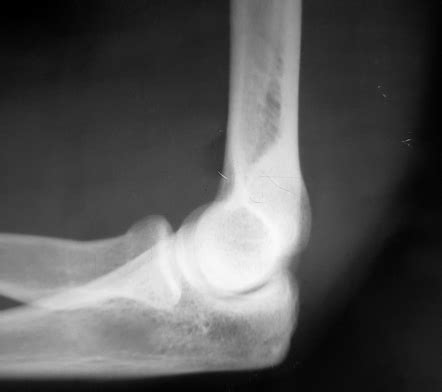 Elbow fat pad (sail sign) | Radiology Case | Radiopaedia.org