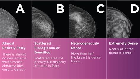 dense breasts mayfair diagnostics