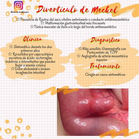 Divertículo de Meckel NeuroMedicine uDocz