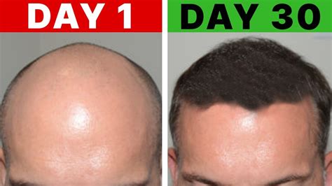 5 Proven Remedies To Prevent Hair Loss And Regrow Hair Youtube