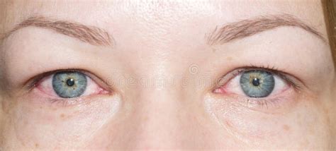 Red eyes stock photo. Image of irritated, allergy, infection - 102612550