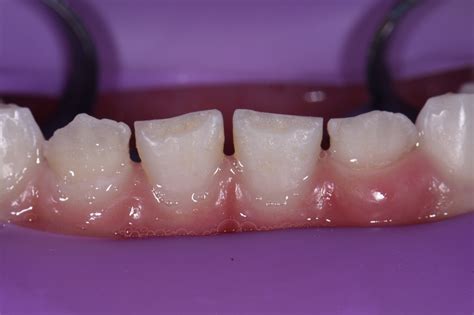 Severe Enamel Dysplasia | Non-Invasive Restorative Dentistry