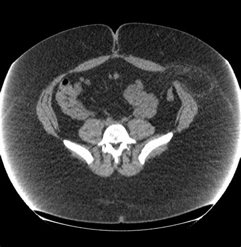 Spigelian Hernia Radiology Reference Article Radiopaedia Org