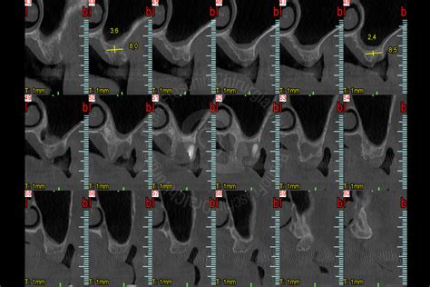 Maxillary Sinus Grafting Fraschini Chirurgia Orale