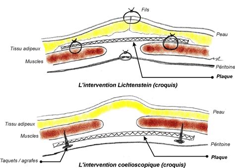 Hernie Ing Fig 4 Docteur Radu MOLDOVANU