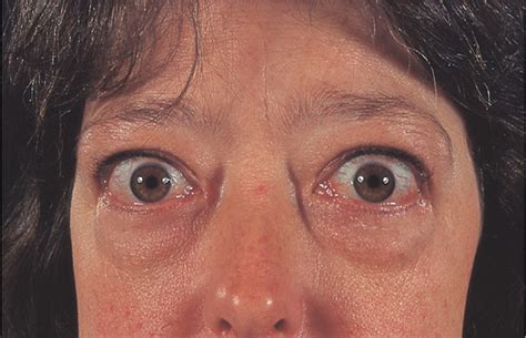 Graves Disease The Lancet