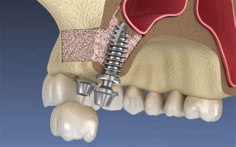 Implantes dentales y recuperación de piezas CD Fibemedic