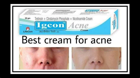 Acne Solutions Igcon Beauty Acne Cream Best Cream For Acne 120rs