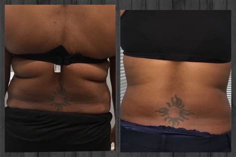 Taft Aesthetics Llc Medical Spa Wilson Nc 27893 Before And After Lipo Dissolve