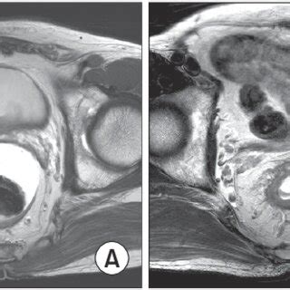 The MRIs of rectal cancer. (A) Rectal cancer with T2N1. (B) Rectal... | Download Scientific Diagram