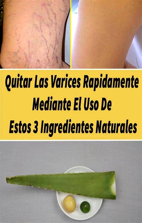 Pin En Remedios Caseros Para Las Varices