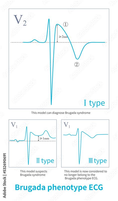 Only type 1 Brugada phenotype ECGs can directly diagnose Brugada syndrome, an inherited cardiac ...