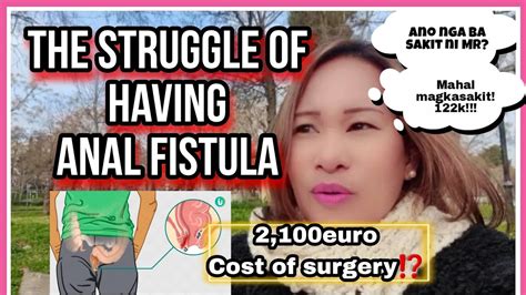 What Is Anal Fistulasigns Symptoms Treatment Cost Of Surgery In