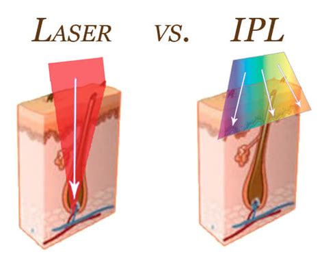 Laser Vs Ipl The Cosmetic Clinic