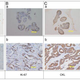 The Expression Of P Ki Ckl And Ck In A Gastric Cancer